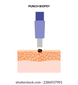 Punch biopsy procedure. Cutting tissue from the surface of the body. Malignant tumor cells tested in a laboratory. Instrument removes specimen from epidermis layer. Skin cancer condition examination.