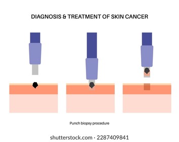 Punch biopsy procedure. Cutting tissue from the surface of the body. Malignant tumor cells tested in a laboratory. Instrument removes specimen from epidermis layer. Skin cancer condition examination.