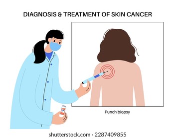 Procedimiento de biopsia de punzonado. Cortar tejido de la superficie del cuerpo. Células tumorales malignas analizadas en un laboratorio. El instrumento elimina el espécimen de la capa de epidermis. Examen del cáncer de piel.