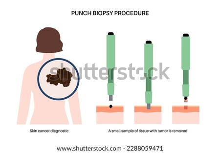 Punch biopsy procedure. Cutting tissue from the surface of the body. Malignant tumor cells tested in a laboratory. Instrument removes specimen from epidermis layer. Skin cancer condition examination.