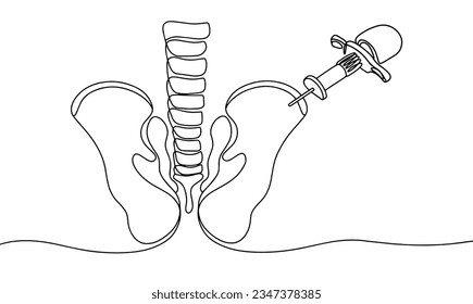 Puncture of the bone marrow from the posterior iliac crest of the pelvis. World Marrow Donor Day. One line drawing for different uses. Vector illustration.