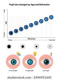 Pupil size changes by Refraction eye ophthalmology, medical diagram