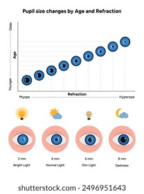 Pupil size changes by Refraction eye ophthalmology, medical diagram