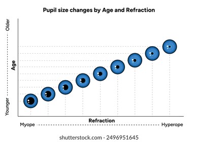 Pupil size changes by Refraction eye ophthalmology, medical diagram