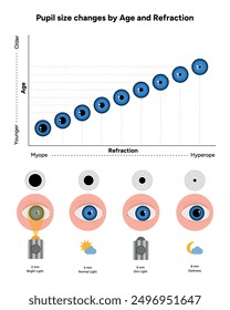 Pupil size changes by Refraction eye ophthalmology, medical diagram