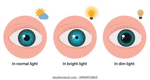 Pupil size changes by Refraction eye ophthalmology, medical illustration