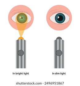 Pupil size changes by Refraction eye ophthalmology, medical illustration