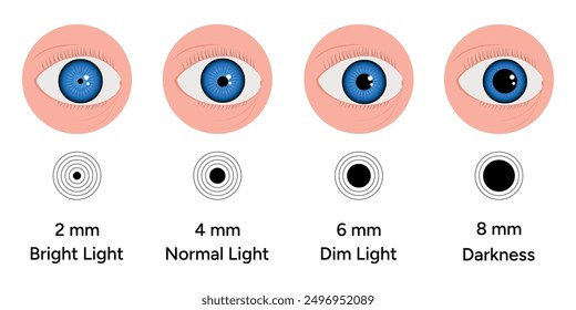 Pupil size changes by Refraction eye ophthalmology, medical information