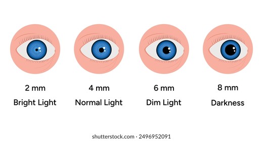 Pupil size changes by Refraction eye ophthalmology, medical information