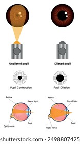 Pupil size in different lighting, Dilated pupil
and Undilated pupil  with Eye anatomy ophthalmology diagram 