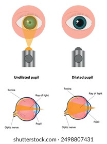 Pupil size in different lighting, Dilated pupil
and Undilated pupil  with Eye anatomy ophthalmology diagram 