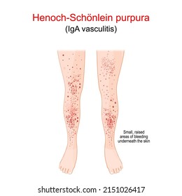 Henoch-Schönlein Purpura. Spotty Rash On The Humans Legs. The Spots Are Caused By Bleeding Underneath The Skin, Platelets, Vascular Or Coagulation Disorders. Vector Illustration