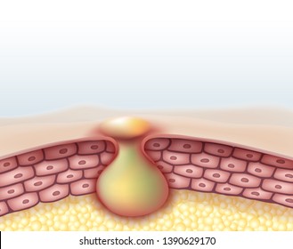 Purulent Inflammatory Acne Or Subcutaneous Abscess.
Vector Realistic File.