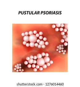 Pustular type psoriasis texture. Eczema, skin disease dermatitis. Infographics. Vector illustration on isolated background.