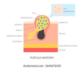Ilustração do vetor plano da anatomia da pústula. Infográfico médico mostrando a estrutura da pele, acúmulo de sebo, inflamação e visão superficial. Cuidados com a pele e conceito dermatológico.