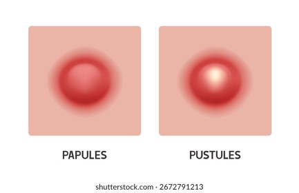 Pústulas y pápulas. Tipos de acné. Vector 3D ilustración