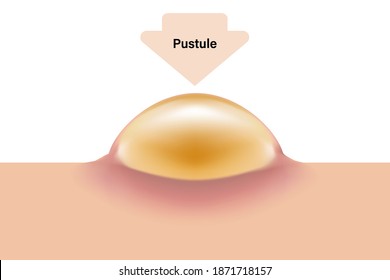 Pustule, Skin acne problems, Inflamed acne