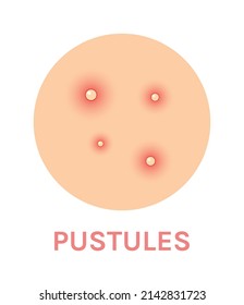 Pustules. Piel problemática con erupción roja. Vista de Acne y Pimples. Icono de color realista. Zoom. Fondo blanco. Ilustración vectorial para diseño médico y de belleza.