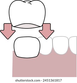 putting on Dental crown, dental treatment - flat illustration 