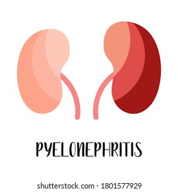 Pielonefritis. Enfermedad de los riñones. Urología. Ilustración plana vectorial. Perfecto para volante, folleto médico, banner, página de inicio, sitio web