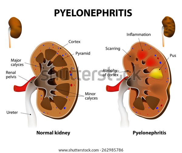 Pyelonephritis Normal Kidney Chronic Pyelonephritis Stock Vector ...