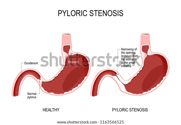 Pyloric stenosis is a narrowing of the opening\
(pylorus) from the stomach to the small intestine. anatomical\
locations the pylorus. stomach of the human. Vector diagram for\
biology and medical\
use