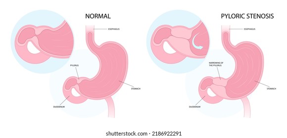 Pyloric Stenosis In Newborn Enlarged Pylorus