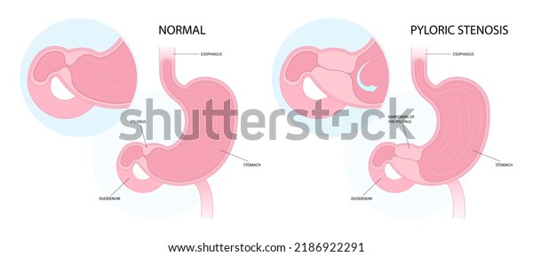 Pyloric stenosis in\
newborn enlarged\
pylorus