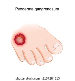 Pyoderma gangrenosum. inflammatory skin disease. Human's foot with a painful ulcer. vector illustration 