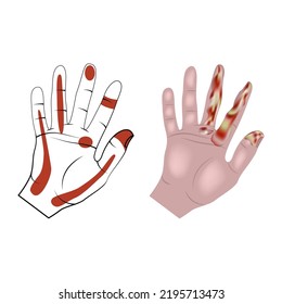 Pyoinflammatory processes of hands and fingers. Infographic with affected areas. Vector illustration