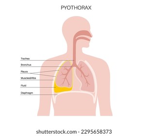 Piotórax y enfiema pleural. Enfermedad inflamatoria pulmonar. Infección en la cavidad torácica y en el área cardiaca. Dolor torácico, dificultad para respirar. Órgano interno poco saludable. Pus o bacterias en el sistema respiratorio