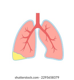 Piotórax y enfiema pleural. Enfermedad inflamatoria pulmonar. Infección en la cavidad torácica y en el área cardiaca. Dolor torácico, dificultad para respirar. Órgano interno poco saludable. Pus o bacterias en el sistema respiratorio