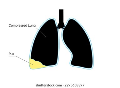 Piotórax y enfiema pleural. Enfermedad inflamatoria pulmonar. Infección en la cavidad torácica y en el área cardiaca. Dolor torácico, dificultad para respirar. Órgano interno poco saludable. Pus o bacterias en el sistema respiratorio