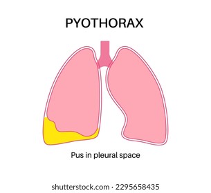 Pyothorax and pleural empyema. Lungs inflammatory disease. Infection in chest cavity and heart area. Chest pain, difficulty breathing. Unhealthy internal organ. Pus or bacteria in respiratory system