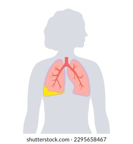 Pyothorax and pleural empyema. Lungs inflammatory disease. Infection in chest cavity and heart area. Chest pain, difficulty breathing. Unhealthy internal organ. Pus or bacteria in respiratory system
