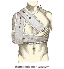 qBroken collarbone - vintage engraved illustration - "Manuel des hospitalière et des garde-malaldes" edited by Librairie Poussielgue - Paris 1907