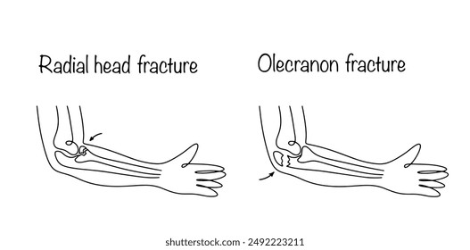 Fractura de cabeza radial y fractura de olécranon. Violación de la integridad de los huesos en el área del codo como resultado de una lesión. Vector aislado sobre fondo blanco.