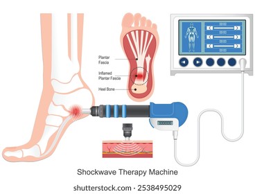 Terapia de ondas de choque radiales para la neuropatía del pie con terapia de ondas de choque extracorpóreas. Promueve el alivio del dolor, la recuperación muscular y la salud de la columna vertebral. (ESWT para abreviar) Atención médica, Ilustración vectorial.