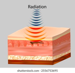 Radiation therapy or radiotherapy. Cancer treatment that uses high doses of radiation to kill cancer cells and shrink tumors. Stereotactic Body Radiotherapy