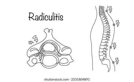 Radiculitis. Inflamación y compresión de los nervios espinales: una vértebra dibujada con la causa del dolor y una columna vertebral con las principales ubicaciones de la radiculitis. Vector médico.