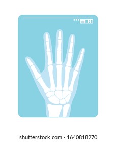 Radiogram of hand. X-ray or roentgenogram. Vector illustration of radiograph