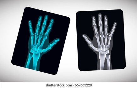 Radiography. Picture of human hands on the film. Vector illustration.