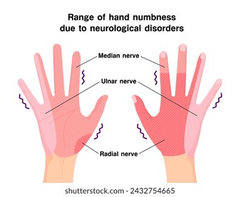 Range of hand numbness due to neurological disorders