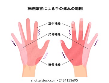 Range of hand numbness due to neurological disorders.  Translation: Neurological disorders 
 range,  median nerve, Ulnar nerve,  Radial nerve.