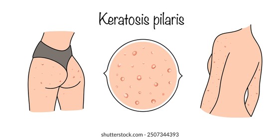 A rare chronic disease accompanied by the formation of yellowish hyperkeratotic areas on the skin of the trunk, extremities, and especially on the skin of the palms and soles. Vector illustration.