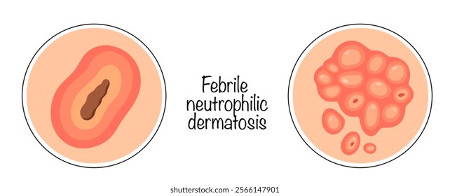 A rare disease from the group of neutrophilic dermatoses, characterized by the formation of painful pink-red papules and edematous erythematous plaques. Manifestation of the disease on the skin.