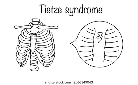 A rare inflammatory disease characterized by chest pain and swelling of the cartilage in the area where the second or third rib attaches to the sternum. Simple line vector illustration.