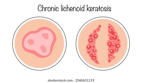 A rare skin disease manifested by the appearance of multiple red hyperkeratic papules. Hand-drawn versions of the appearance of lichenoid keratosis chronicus on the skin. 