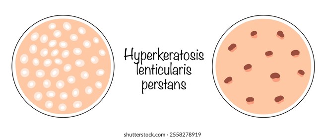 A rare type of keratosis pilaris, which is characterized by the presence of widespread small horny papules. Color vector illustration with variants of the manifestation of the disease on the skin.