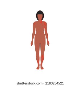 Rash on female body with tanned skin. Painful dermatitis in slender woman. Meningitis rash. Skin disease, allergy. Spots all over body. Patient with meningitis symptoms. Disease manifestation signs.